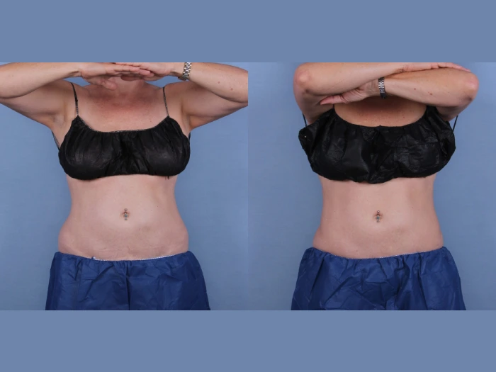 Coolsculpting in Dubai