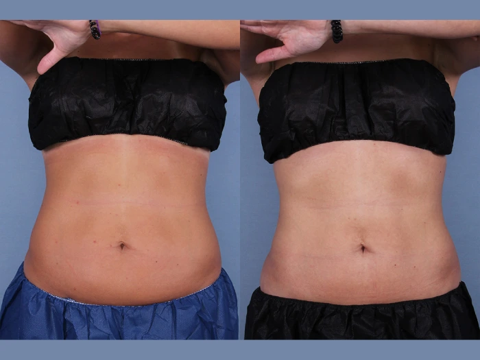 Coolsculpting Before After Result