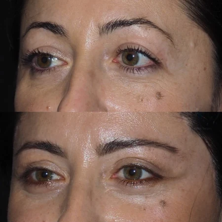 Upper Eyelid Fat Transfer Surgery in Dubai Uae