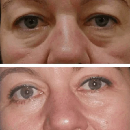 Upper Eyelid Fat Transfer for Male in Dubai Abu Dhabi Uae