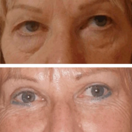 Upper Eyelid Fat Transfer Results in Dubai