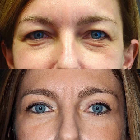 Upper Eyelid Fat Transfer Surgery in Dubai