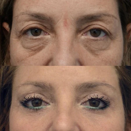Before and After Images for Upper Eyelid Fat Transfer Surgery in Dubai