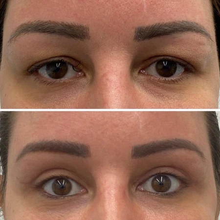 Upper Eyelid Fat Transfer Surgery in Abu Dhabi