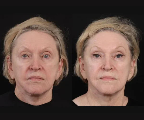 Thermage Tightening Before and After Dubai