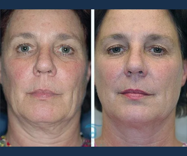 Thermage Skin Care Results Before and After Uae