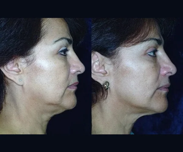 Thermage Skin Lifting Results Before After Uae