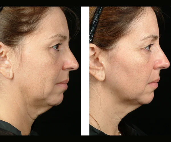 Thermage Non-surgical Facelift Before After Uae