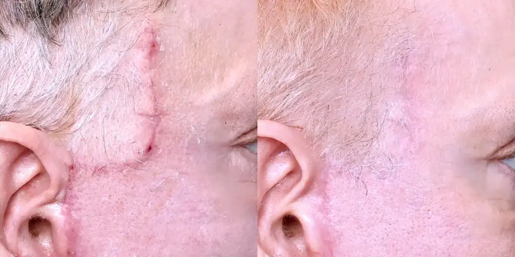Scar Removal Before and After Images in Dubai