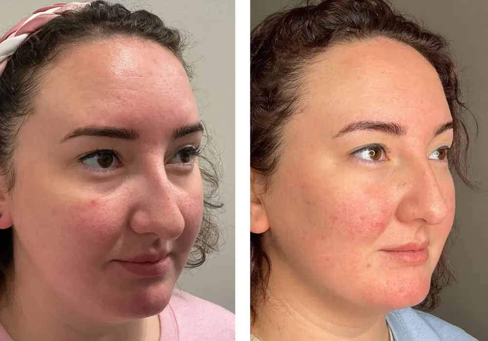 Hydrafacial Before and After Recovery in Uae