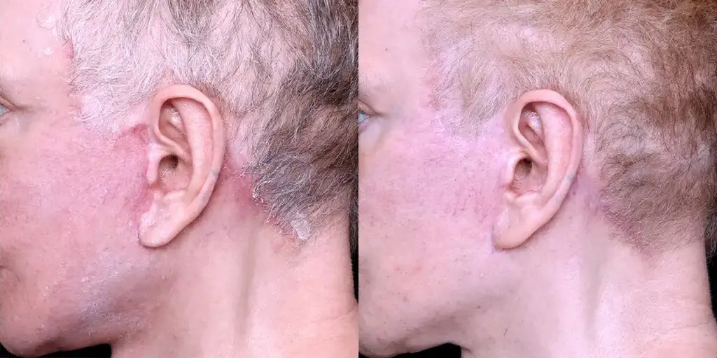 Scar Removal in Uae