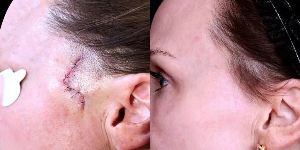 Scar Removal Recovery in Dubai