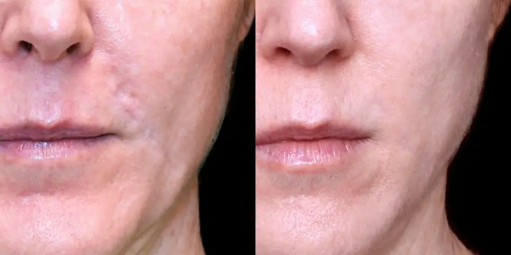Scar Removal in Dubai for Male