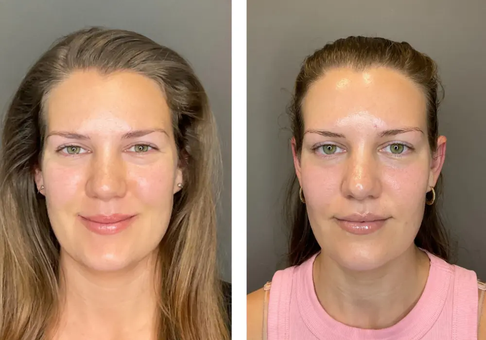 Hydrafacial Before and After in Uae