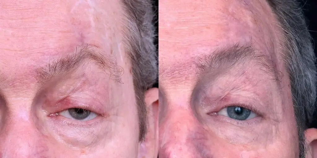 Scar Removal in Dubai