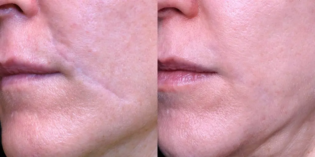 Scar Removal in Dubai Abu Dhabi