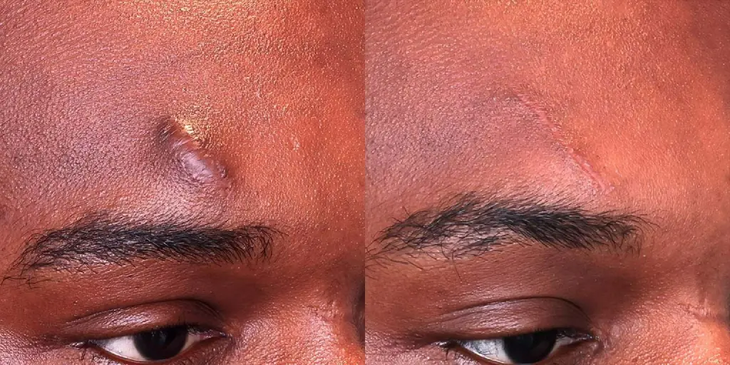 Scar Removal for Male in Uae