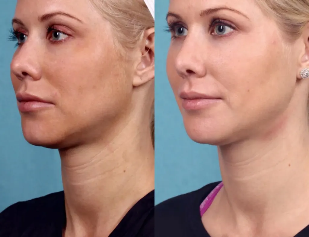 Best Ultherapy Lift Results in Dubai