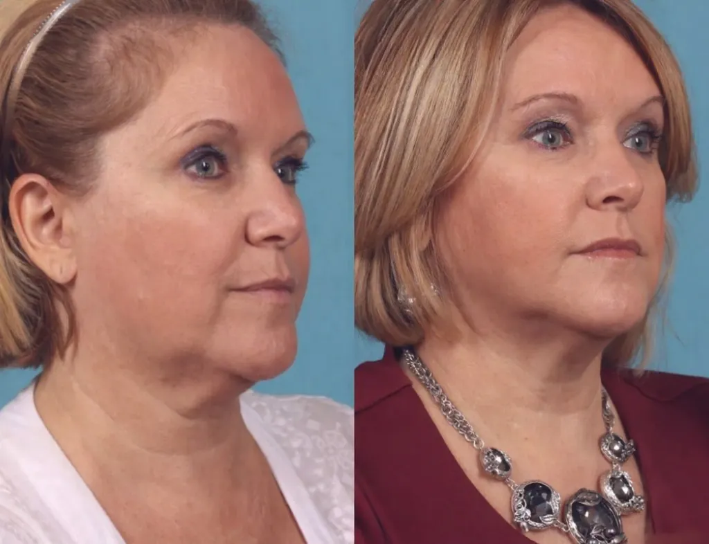 Ultherapy Anti-aging Therapy Abu Dhabi