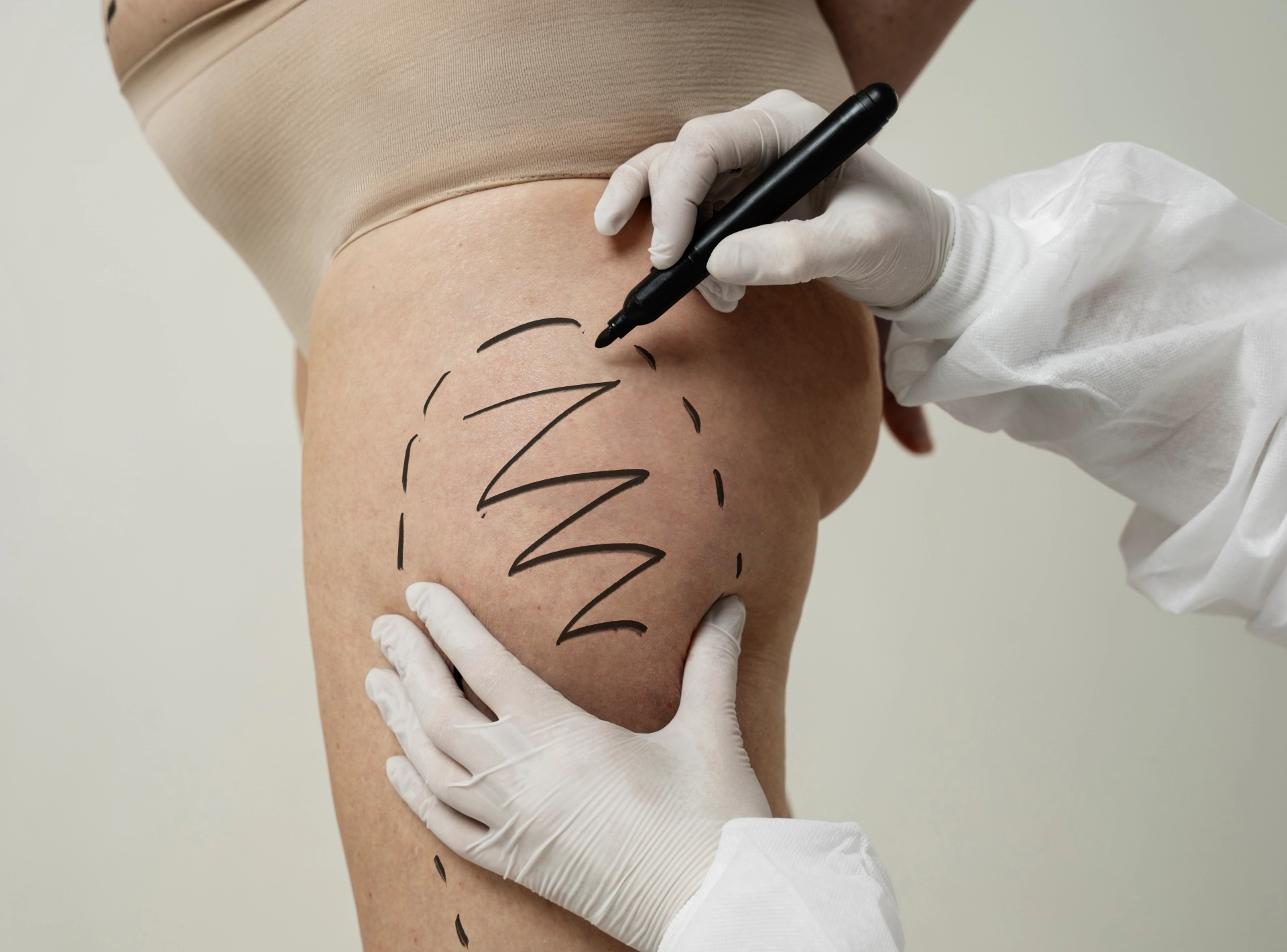Thigh Liposuction Results and Achievable Difference