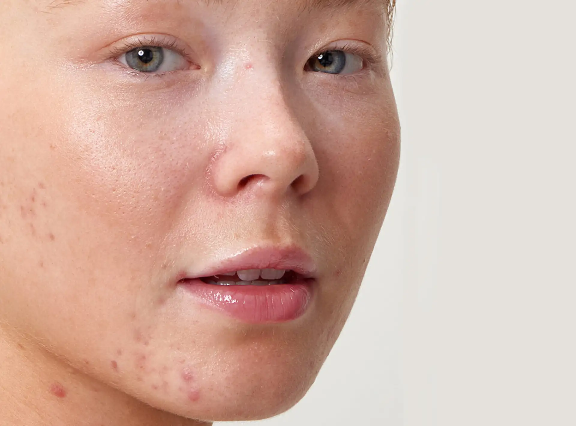 Acne Scars Treatment in Dubai
