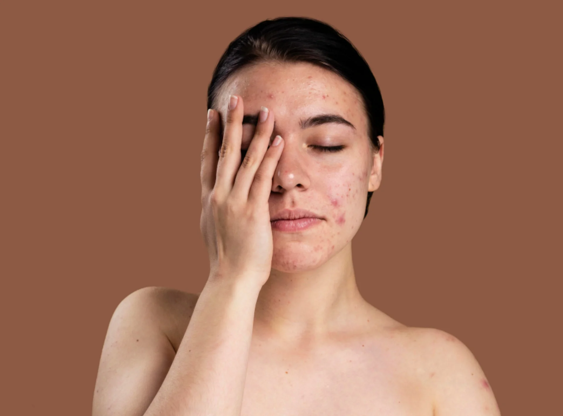 Acne Scar Treatment in Dubai