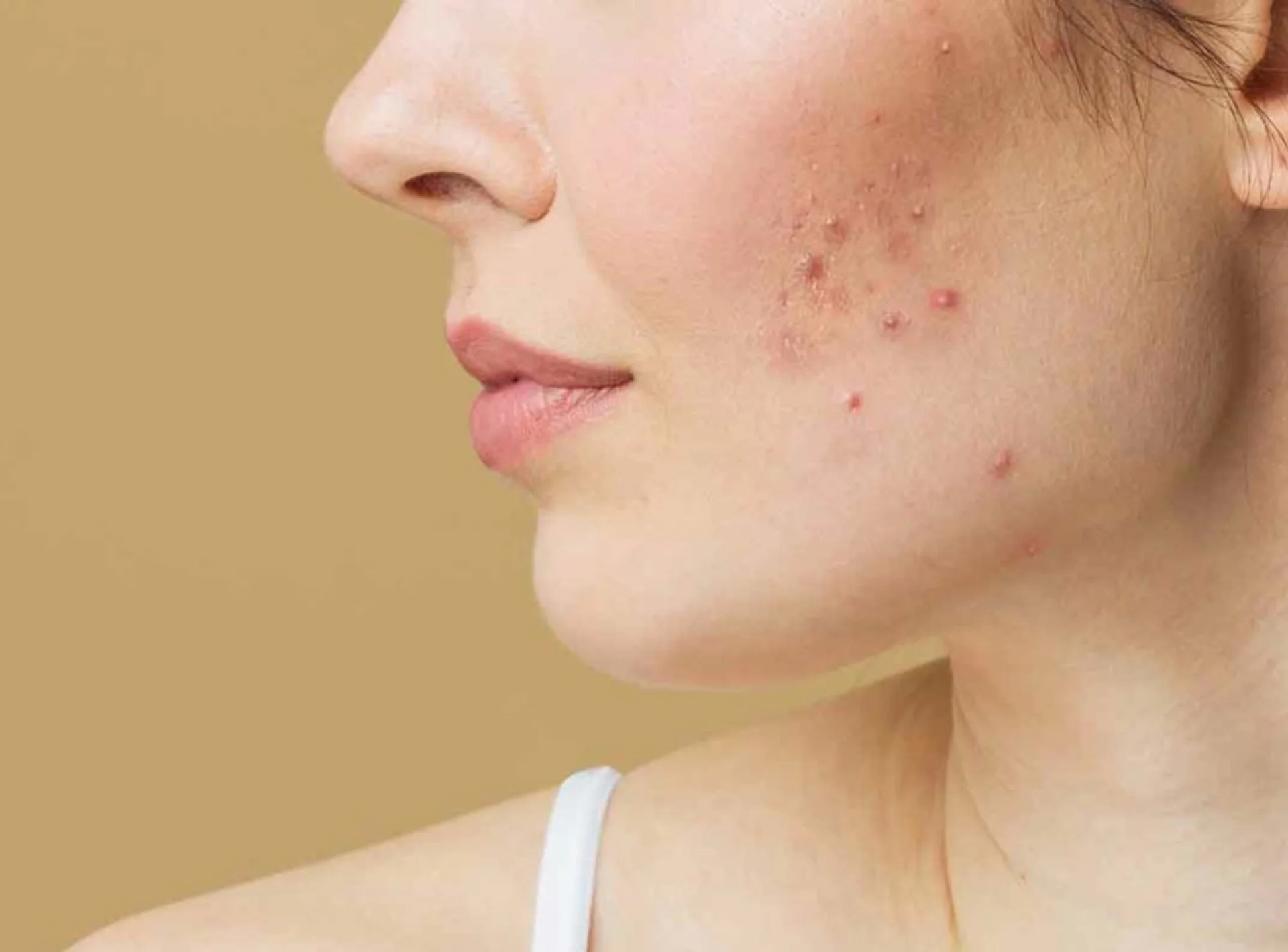 Acne Treatments in Dubai