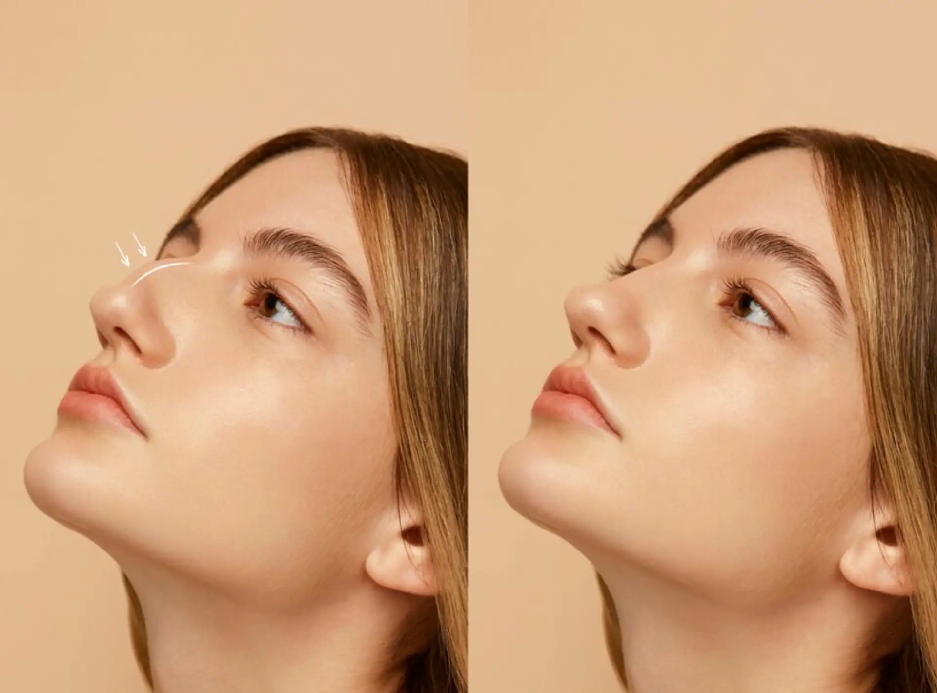 Non-invasive Rhinoplasty in Dubai
