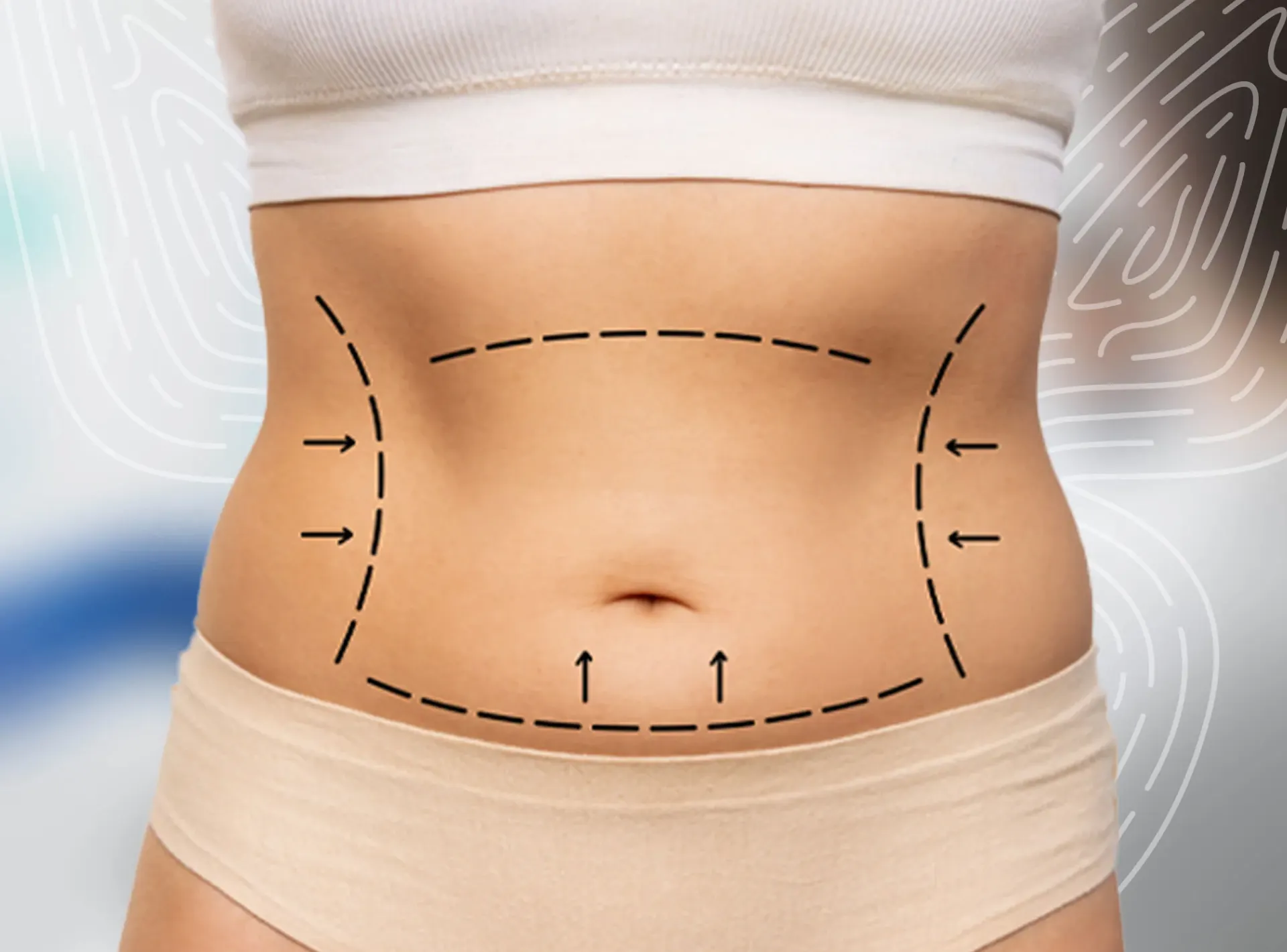 Liposuction Surgeon in Dubai
