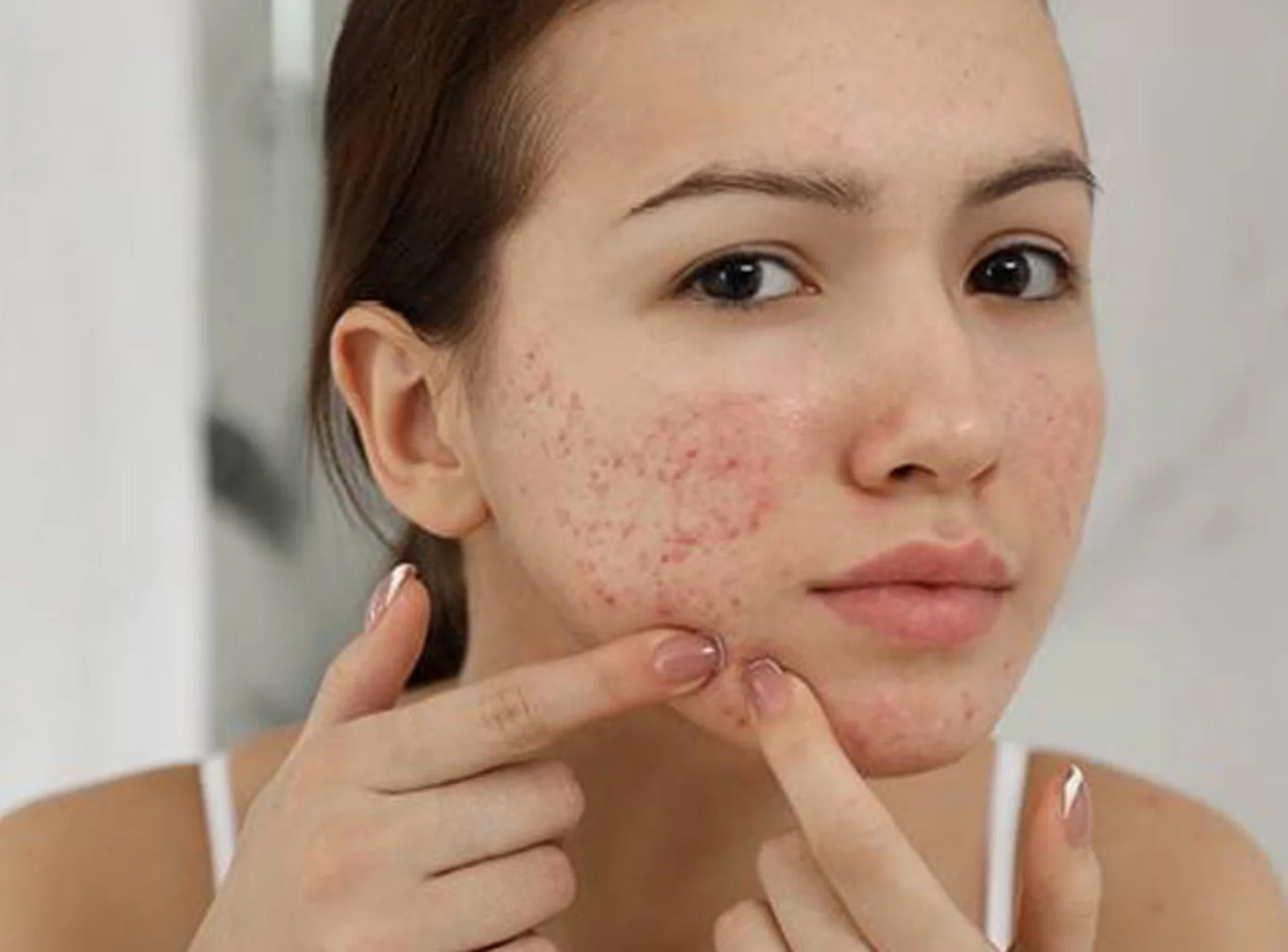 Acne Treatments in Dubai
