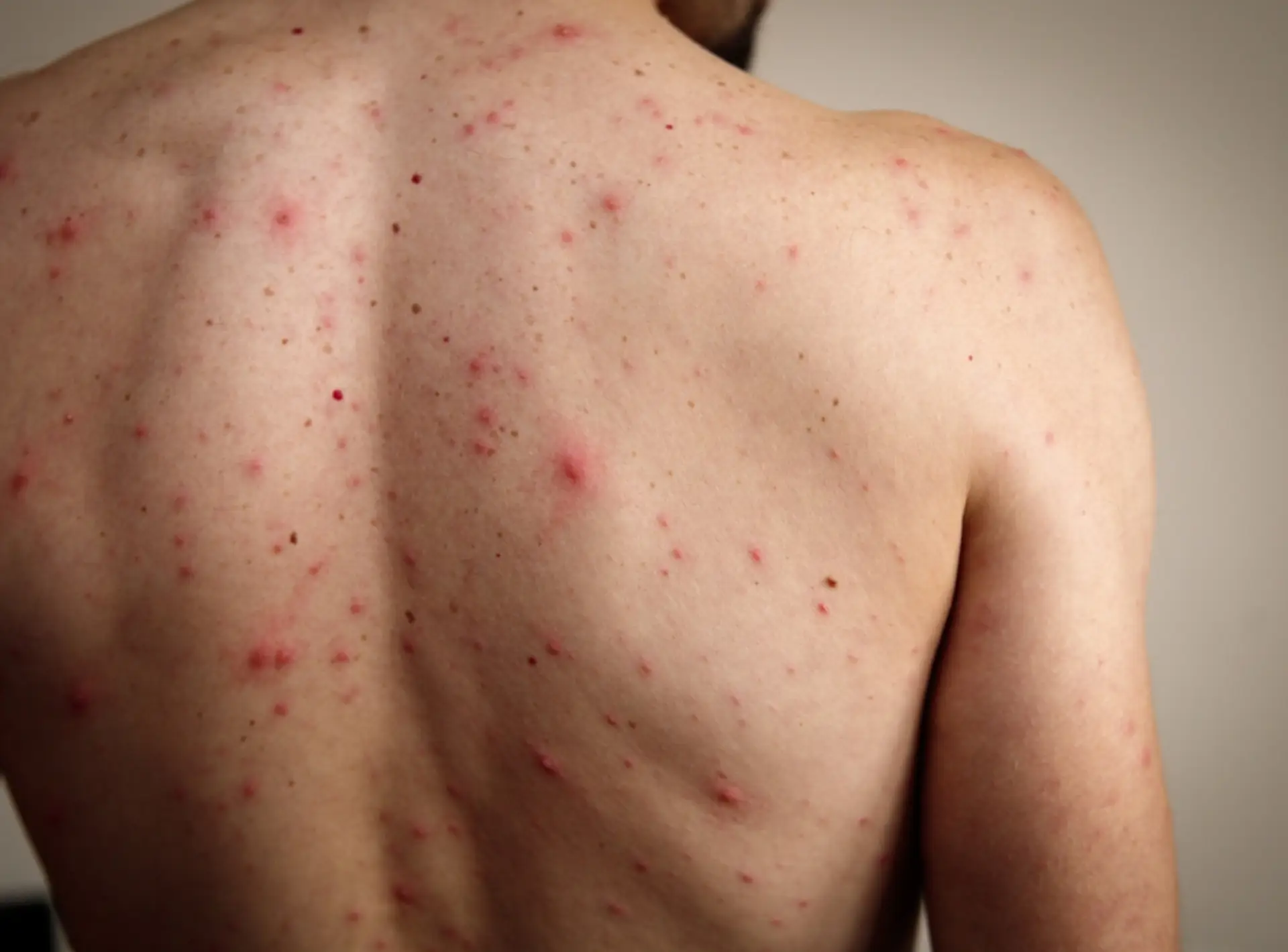 Acne Treatment in Dubai