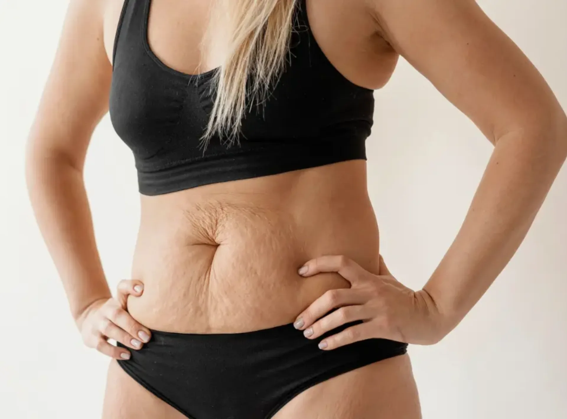 Tummy Tuck in Dubai