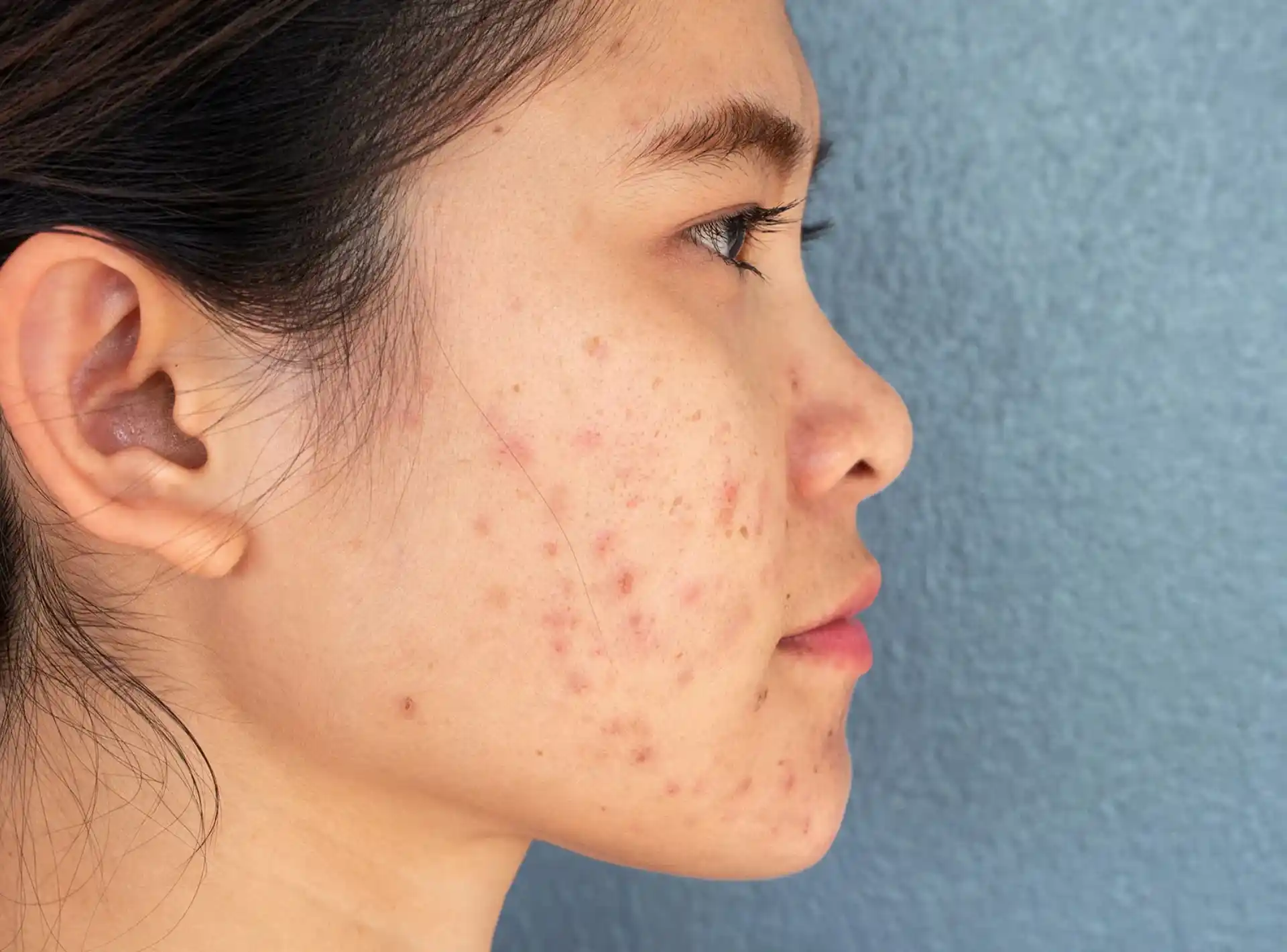 How To Prevent Acne Scarring | Perfect Doctors Clinic