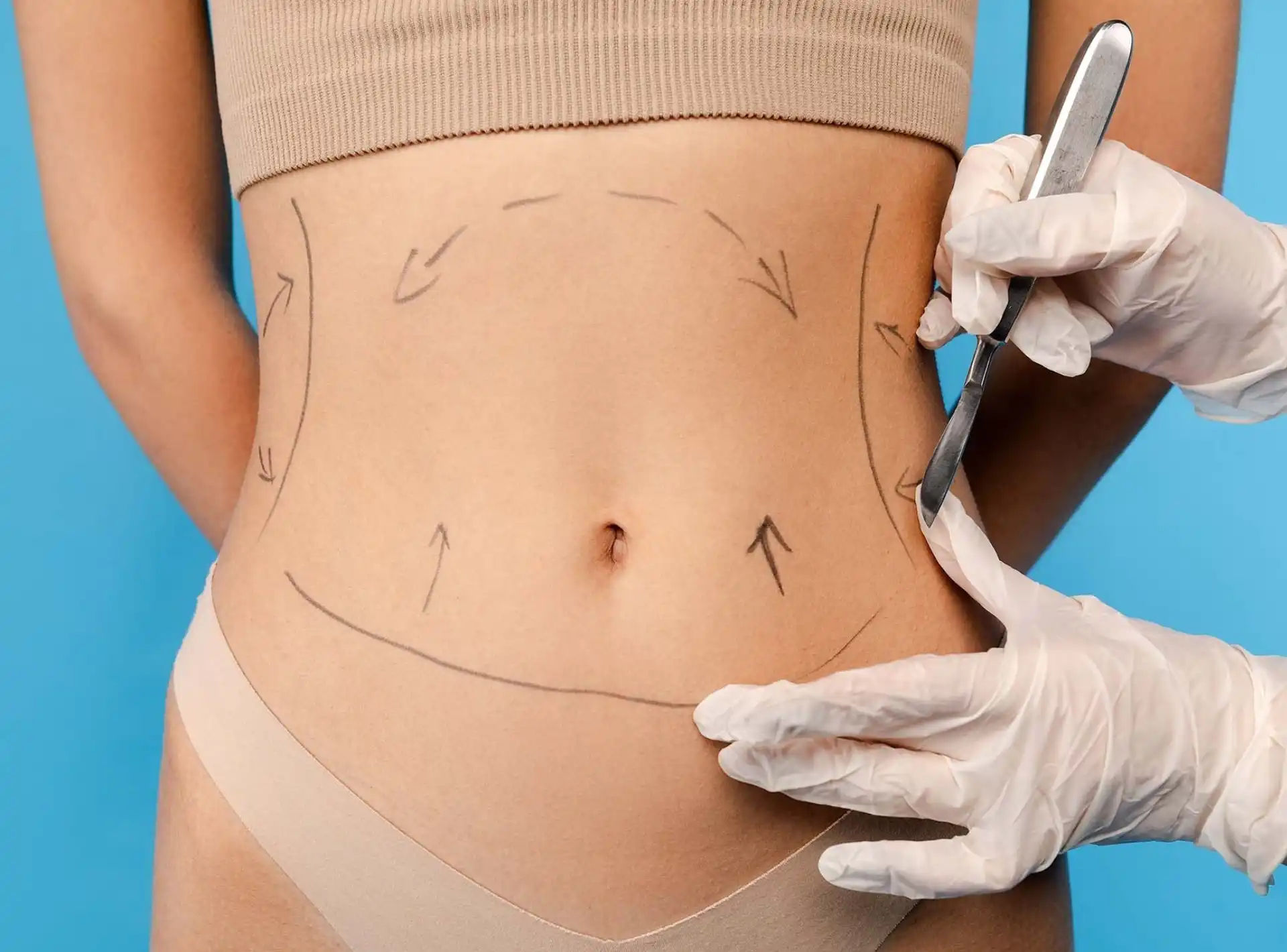 the Purpose and Procedure of Liposuction