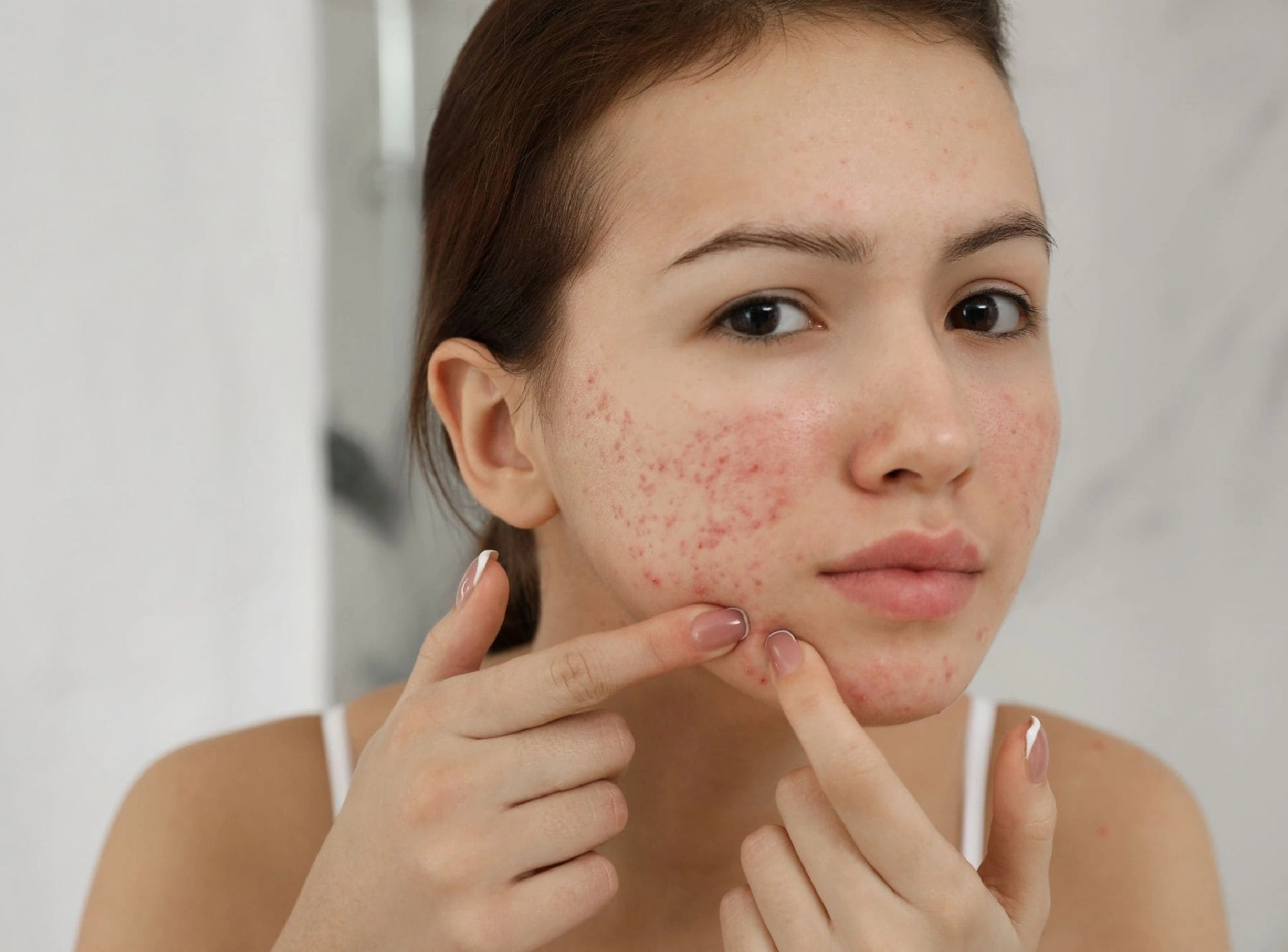 Acne Treatments: What's the Right Treatment for You?