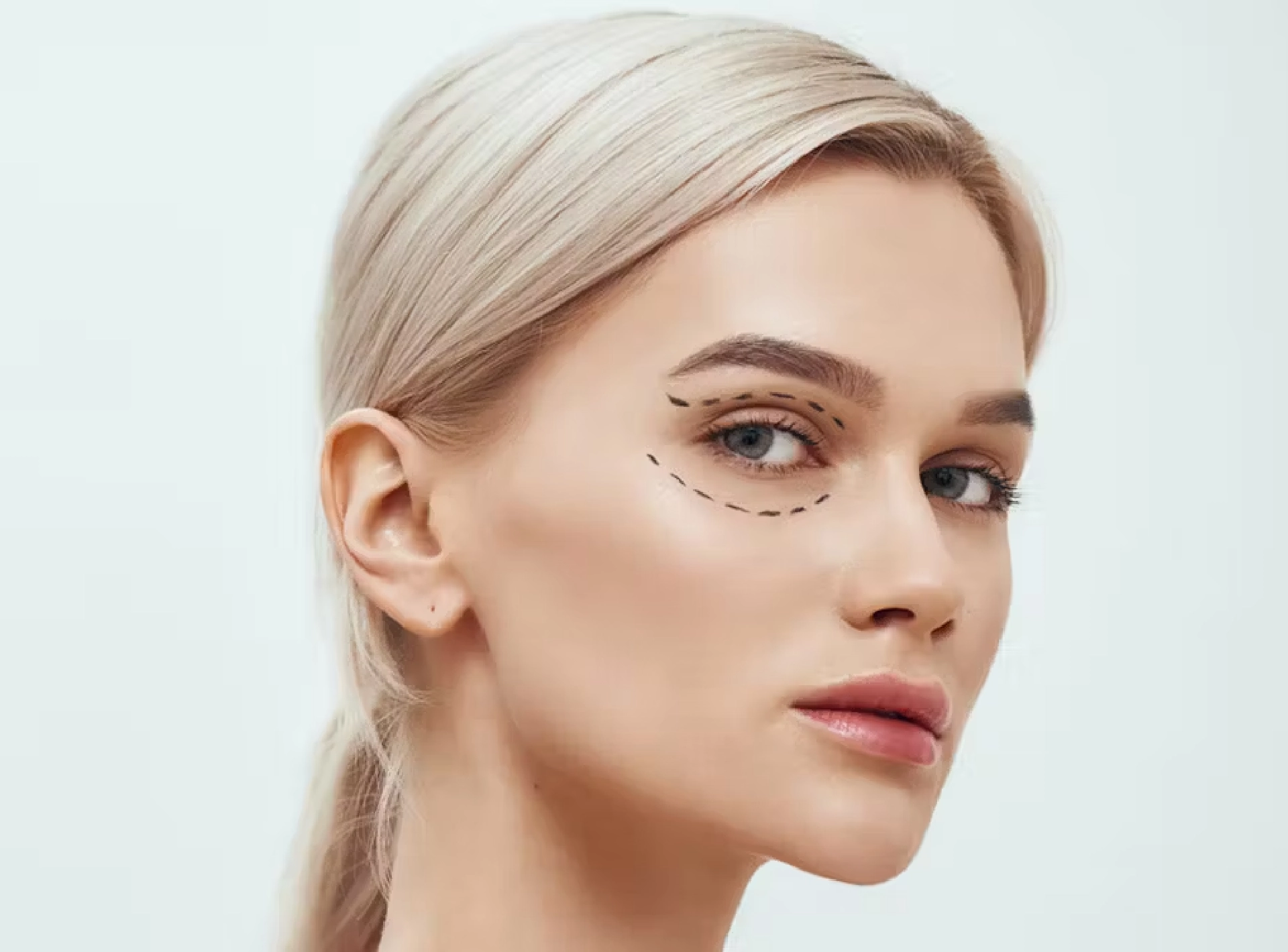 What to Expect During Blepharoplasty Recovery