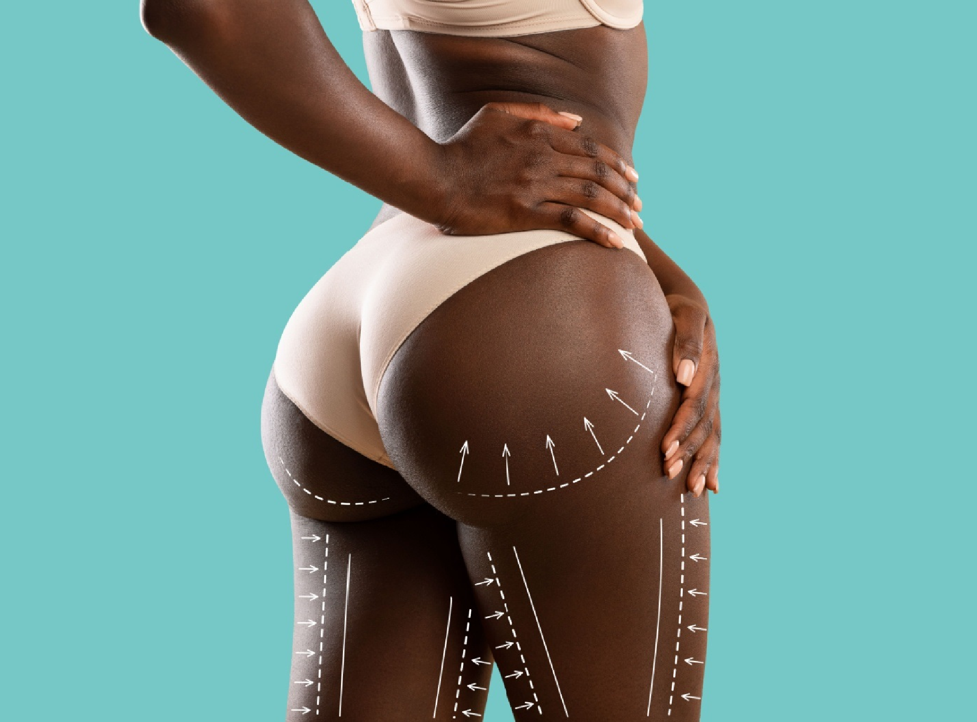 Minimize the Risk of Fat Embolism in Brazilian Butt Lift Procedures