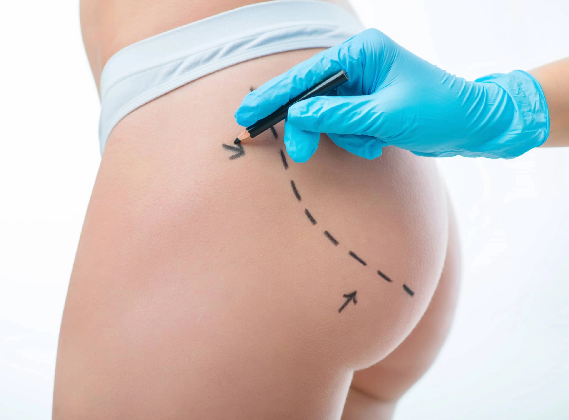 Fat Transfer Buttock Augmentation Leads to Great Results