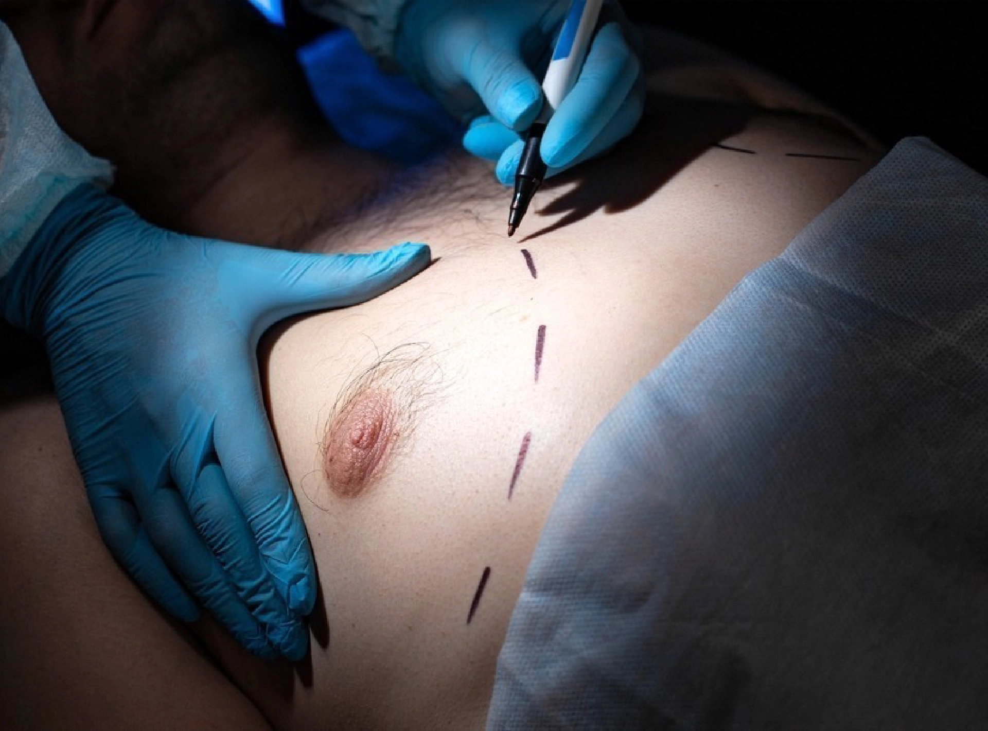 Your Guide to Gynecomastia in Adults