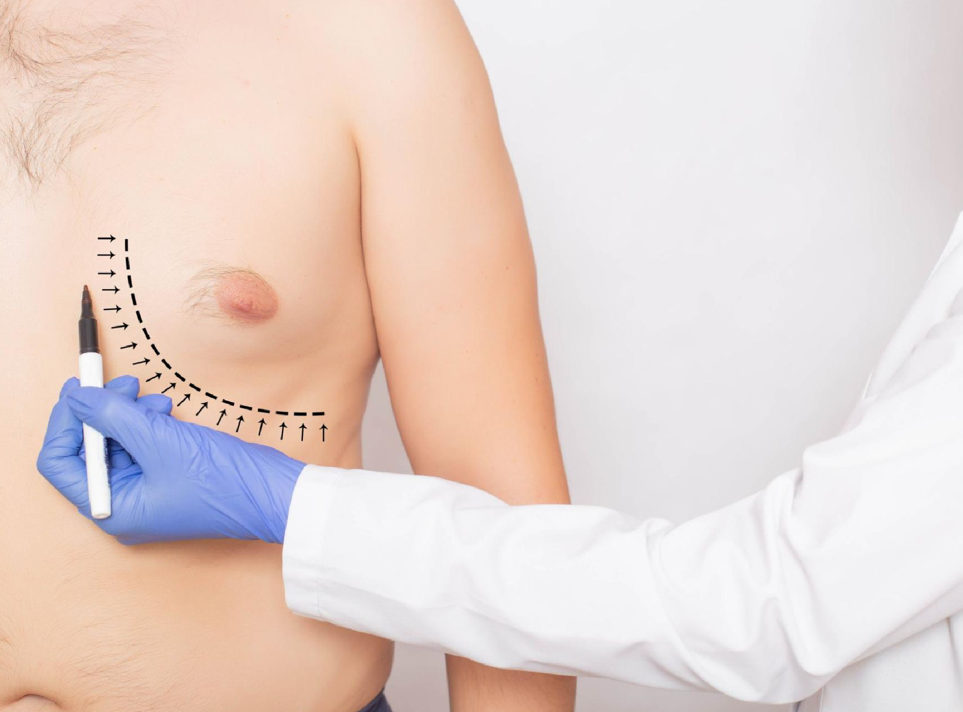 Gynecomastia Surgery: Safety and Risks