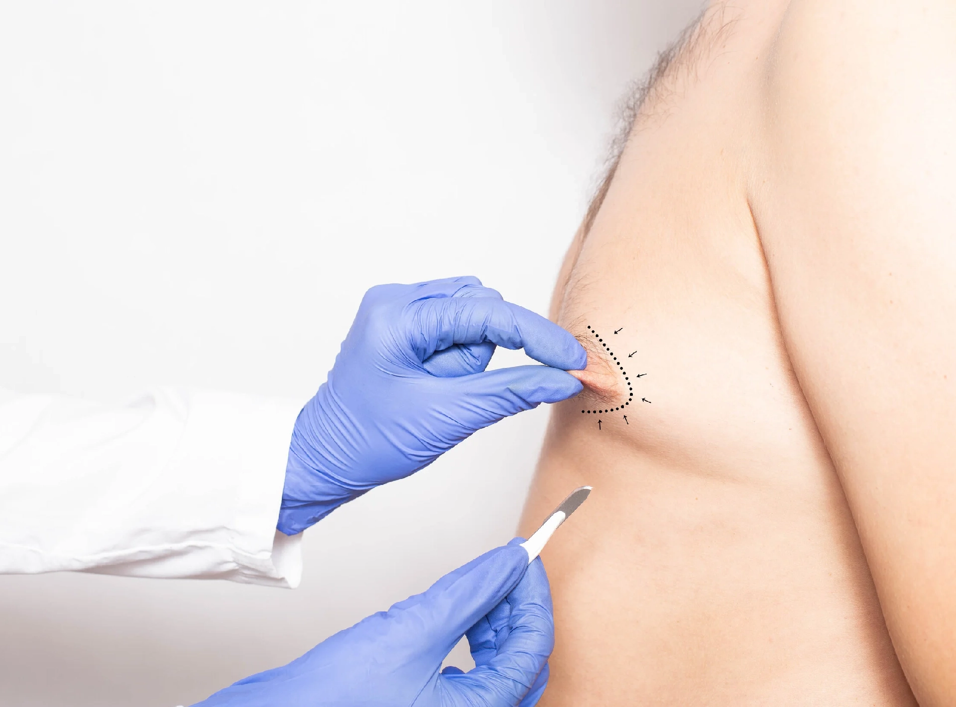 Gynecomastia Surgery Scars
