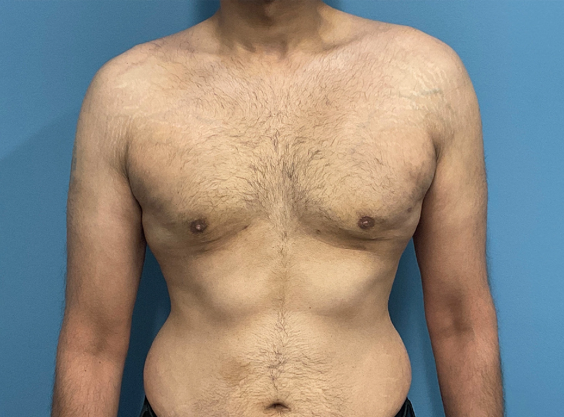 Main Gynecomastia Causes