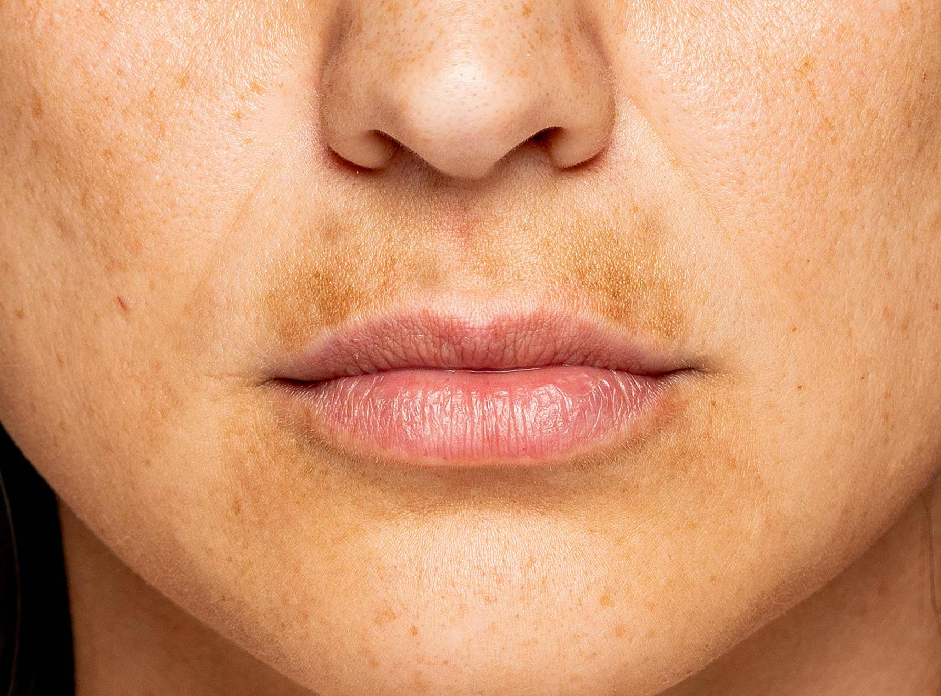 Microneedling Help with Melasma