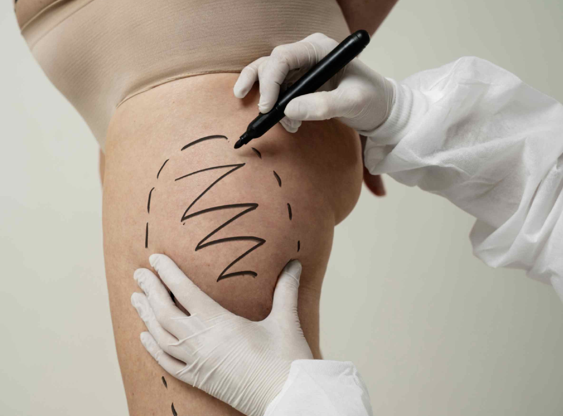 Does Nonsurgical Fat Reduction Work?
