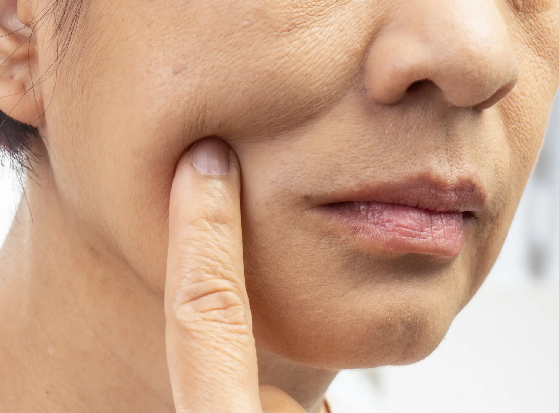 Rf Microneedling for Sagging Skin