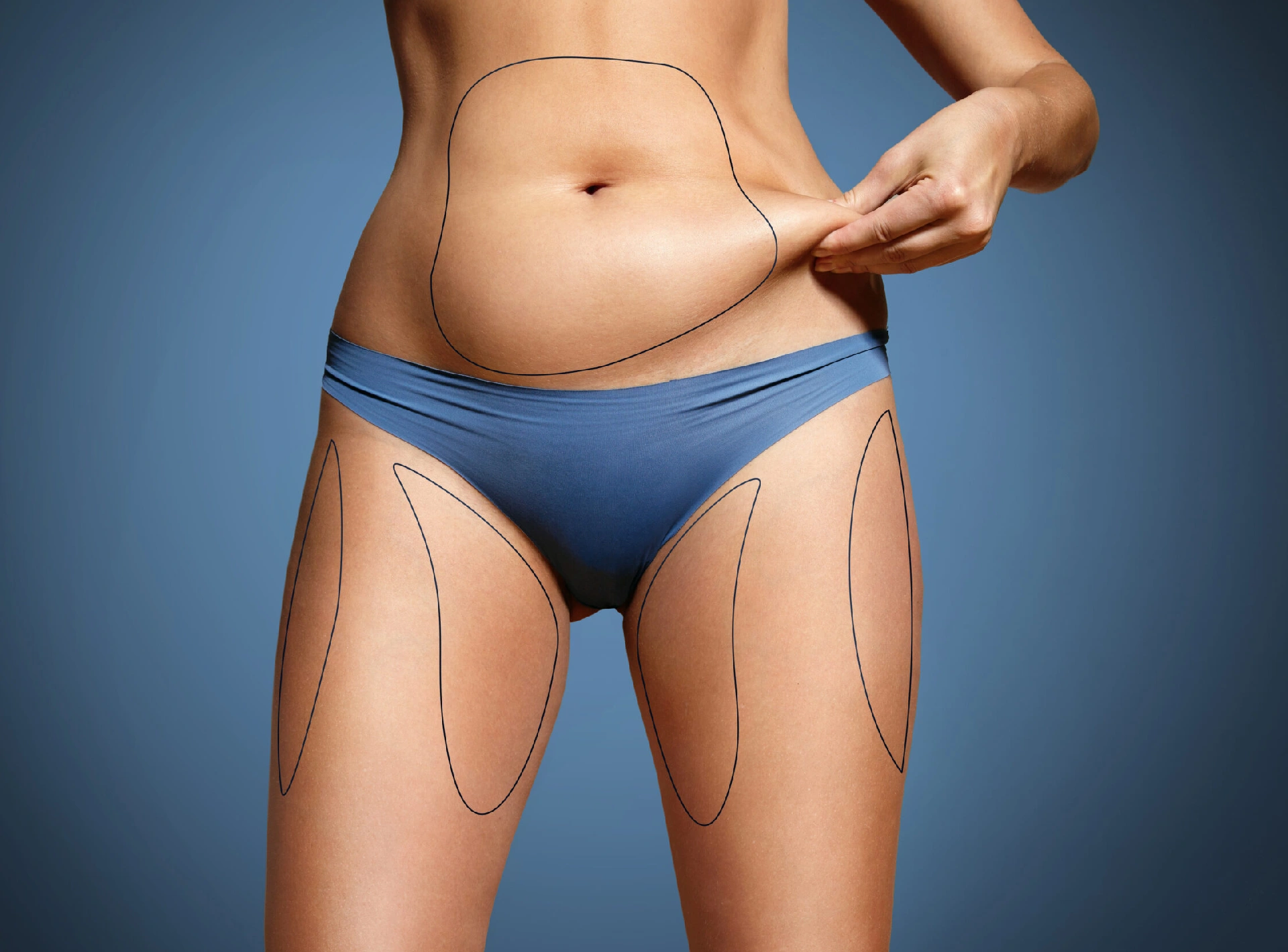 Combined Tummy Tuck and Liposuction for Body Contouring in Dubai
