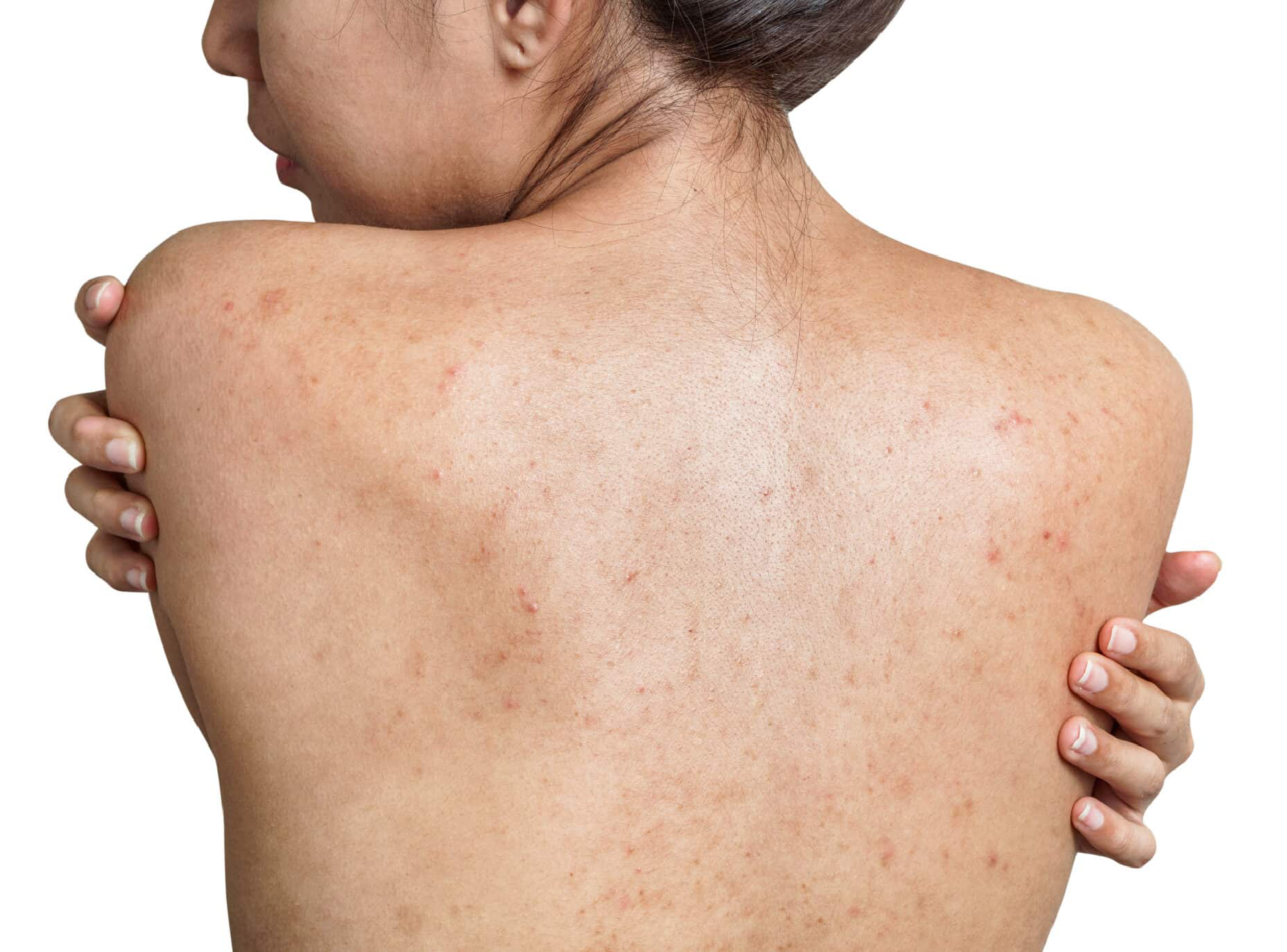 It's Acne Awareness Month!