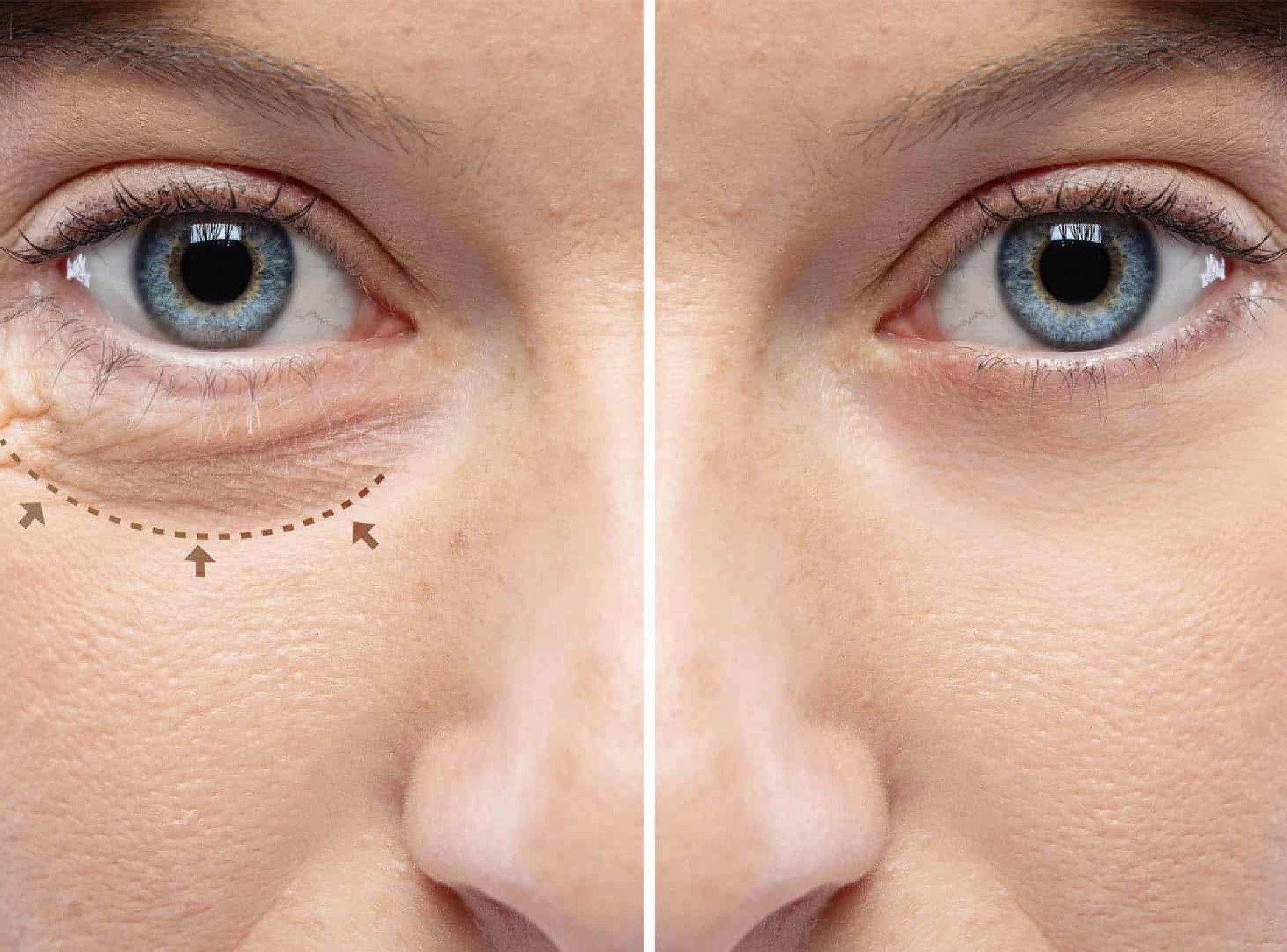 How Long Does a Blepharoplasty Last?