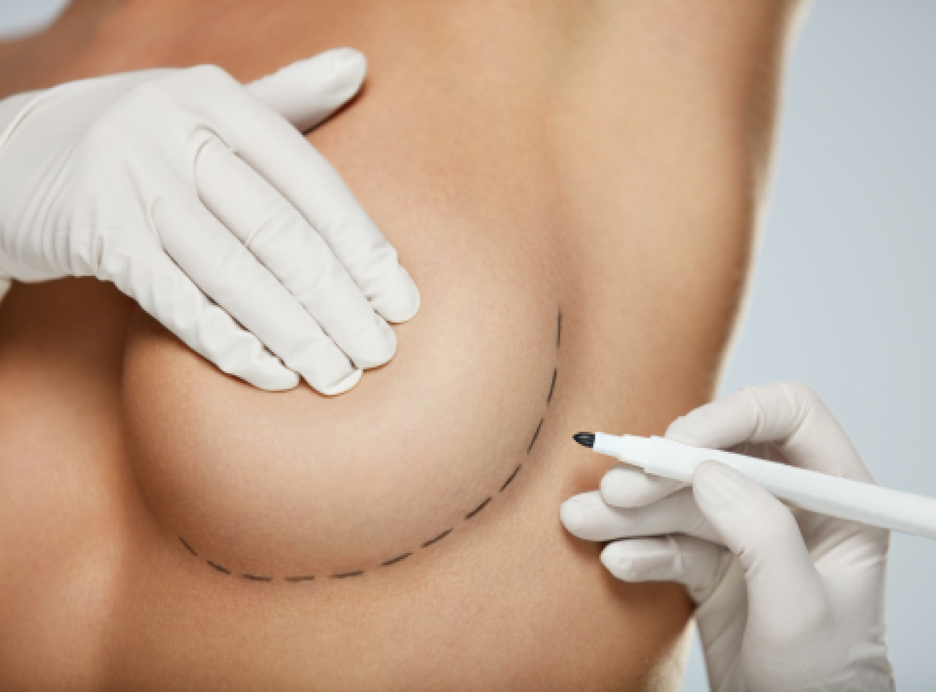 Breast Augmentation Healing Time