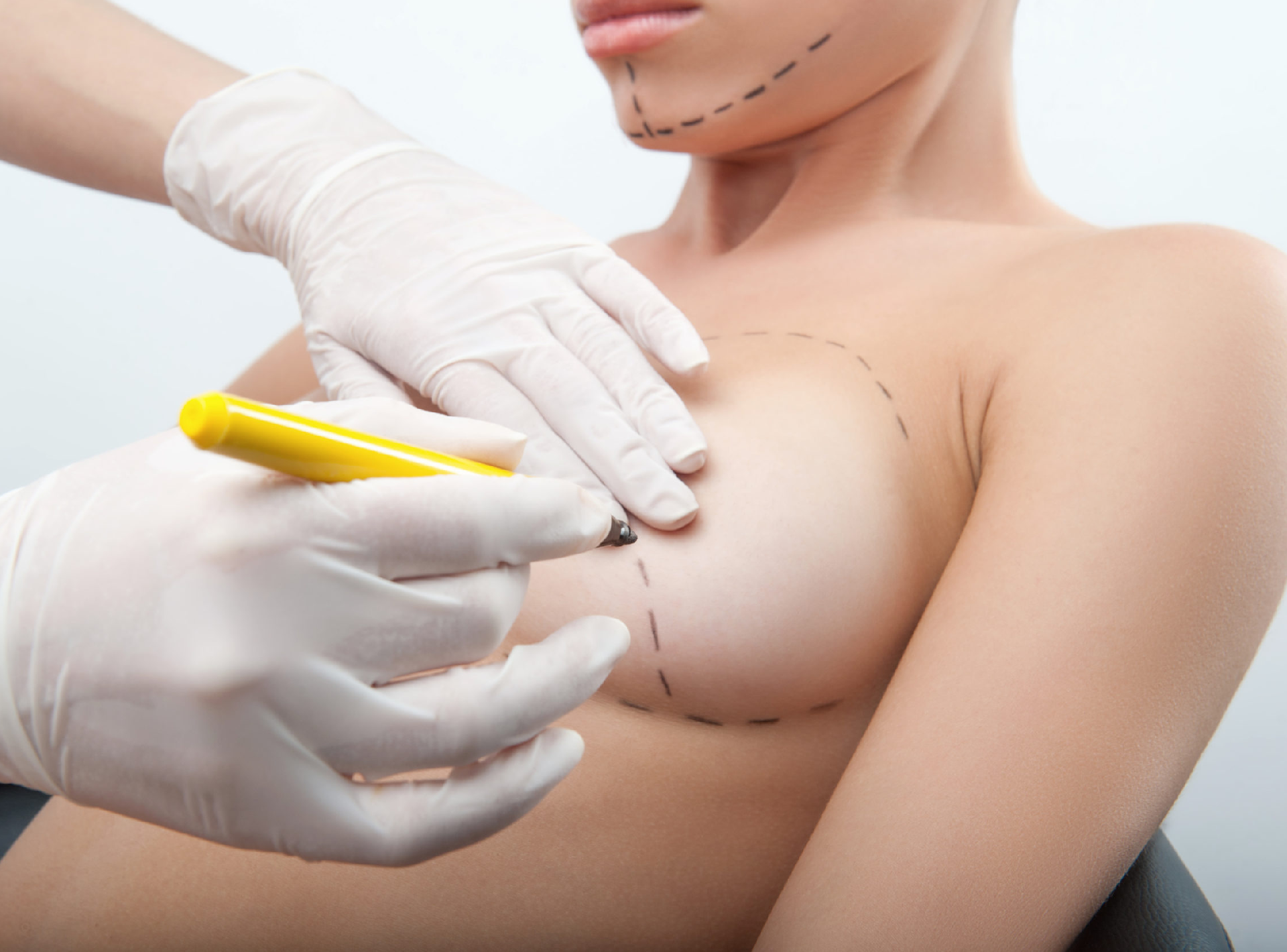 High, Moderate, or Low Breast Implant Profile